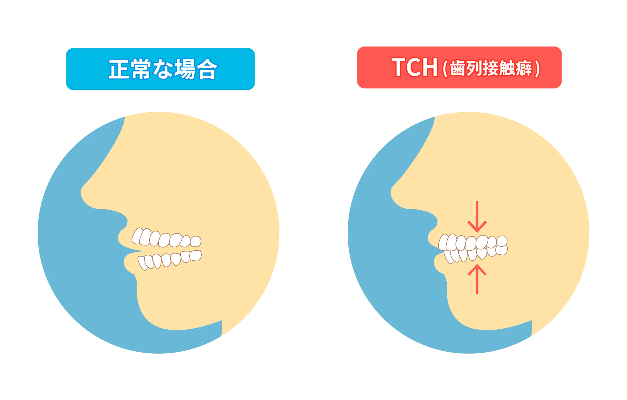 本所吾妻橋（浅草）徒歩3分の歯医者、鈴木歯科クリニックの歯ぎしり・食いしばり