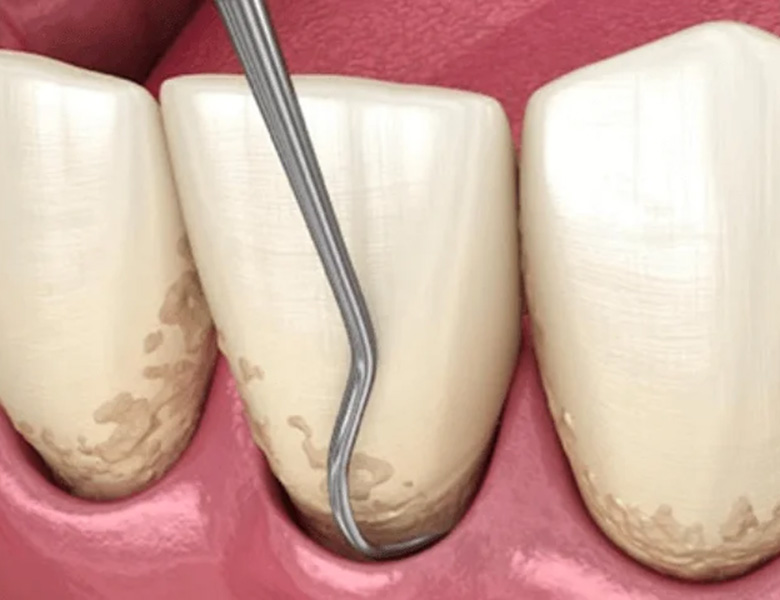 本所吾妻橋（浅草）徒歩3分の歯医者、鈴木歯科クリニックの歯周病治療
