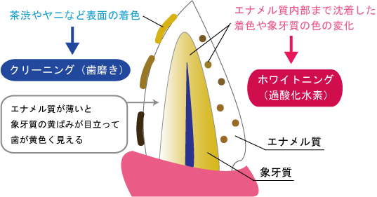 本所吾妻橋（浅草）徒歩3分の歯医者、鈴木歯科クリニックのホワイトニング